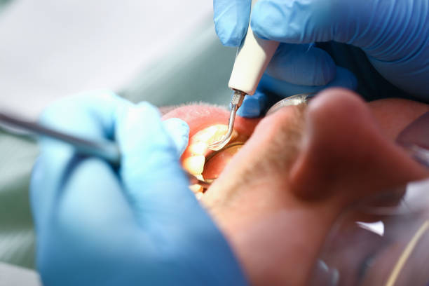 Best Emergency Dentist for Lost Fillings or Crowns in Guernsey, WY